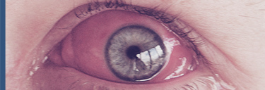 conjuntivite
