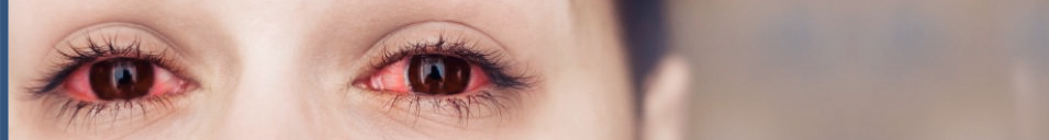 doencas-oculares-conjuntivite